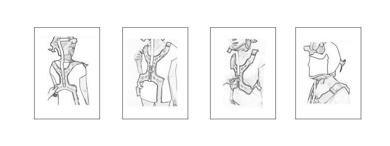 Instructions For Use The Cervical Thoracic Orthosis