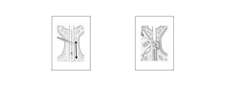 How To Adjust The Cervical Thoracic Orthosis